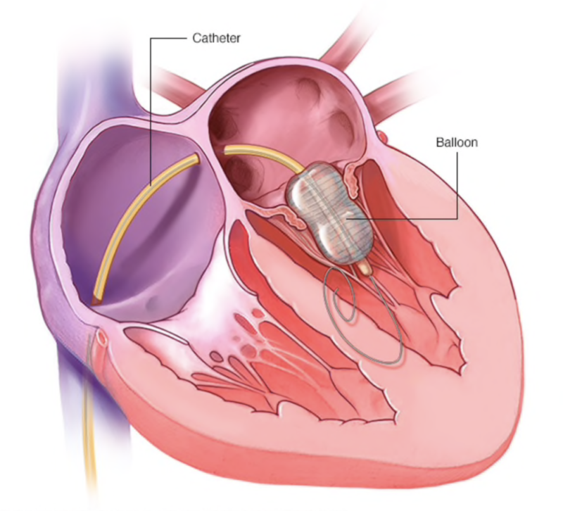 Bệnh mạch vành là bệnh tim có ở nam lẫn nữ. 